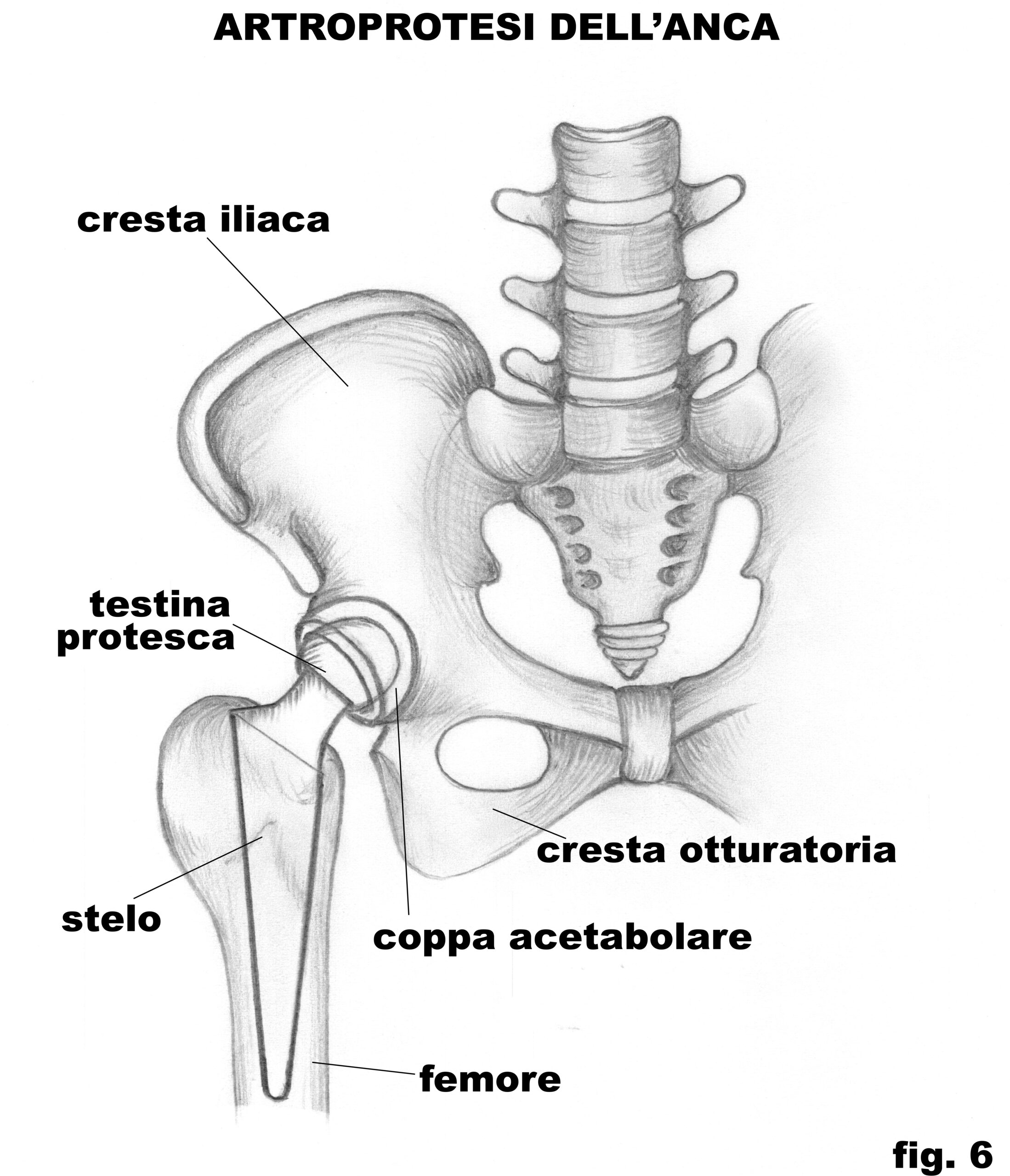 artroprotesi_dell_anca_6