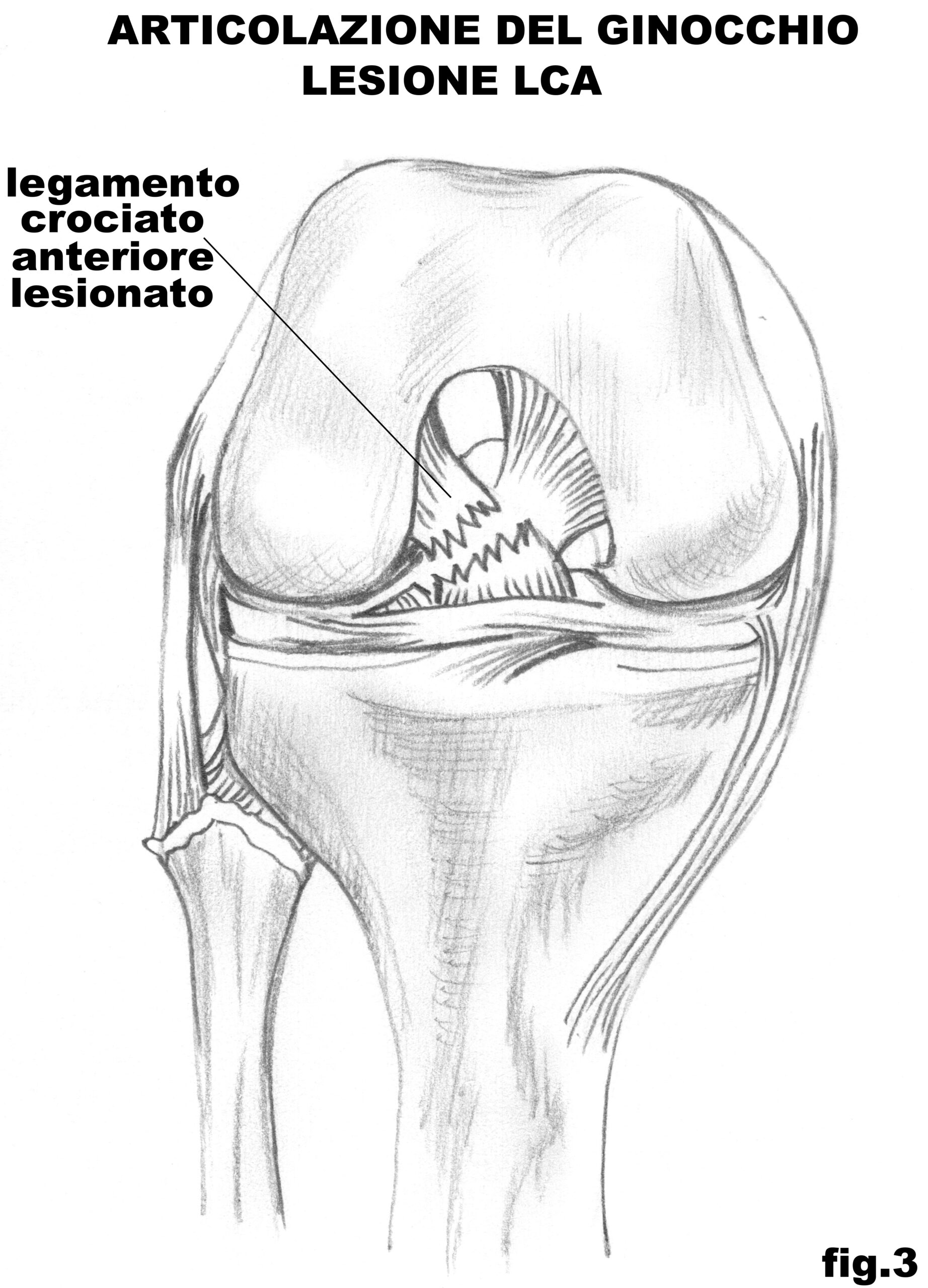 ginocchio_lesione_LCA_3