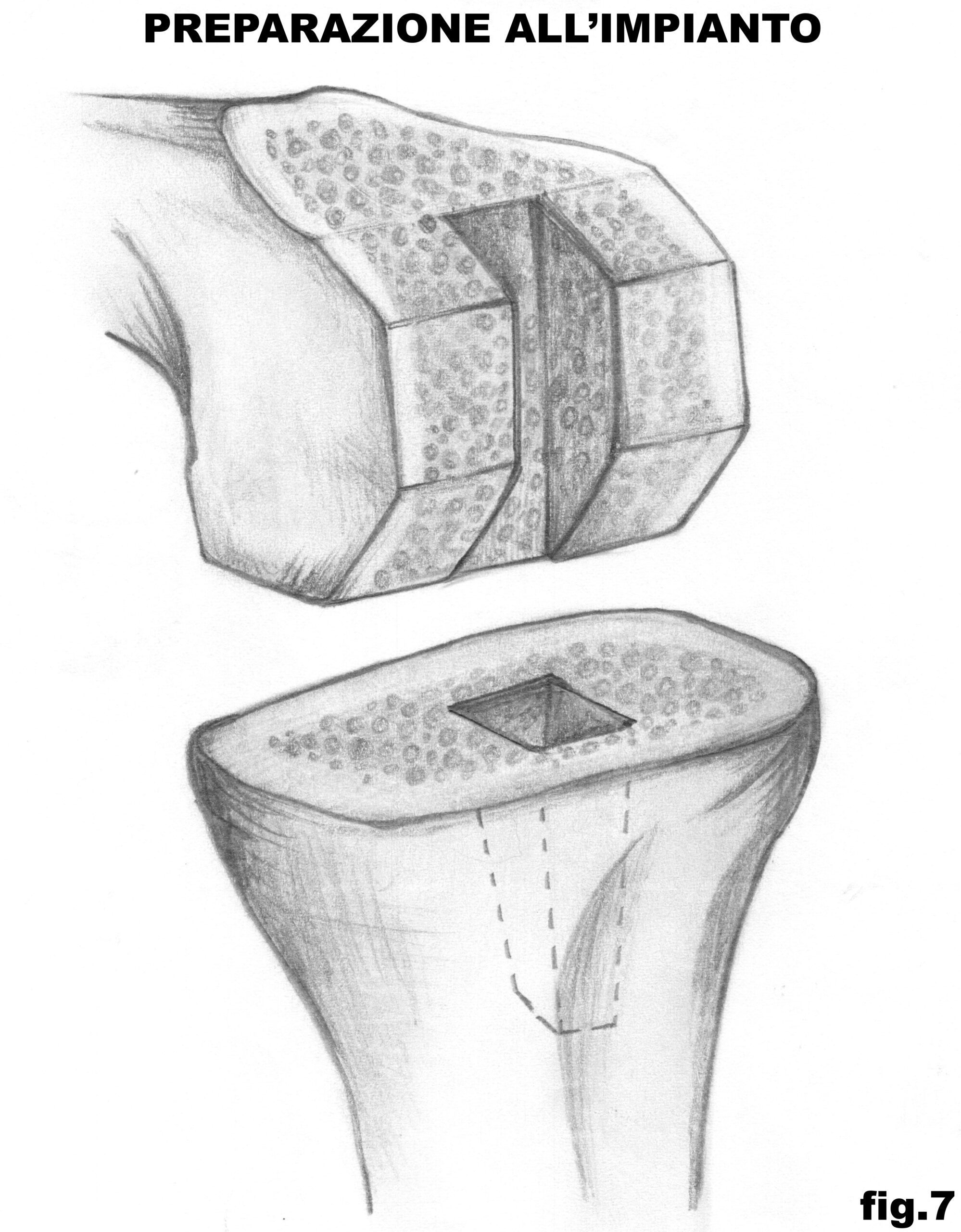 ginocchio_prep_impianto_7